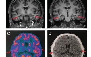 医生发现19岁阿尔兹海默症患者 已知最年轻患者 医生称检查时一度不敢相信