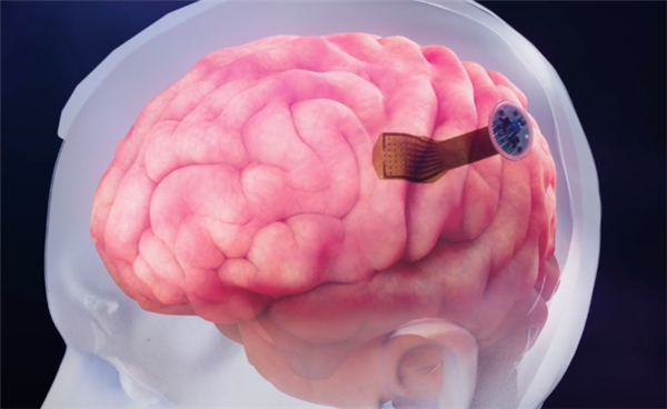 马斯克合伙人研制大脑“第七层” :瘫痪病人可用意念操作电子设备-第1张图片-9158手机教程网 马斯克合伙人研制大脑“第七层” :瘫痪病人可用意念操作电子设备-第1张图片-9158手机教程网