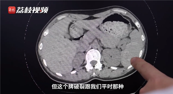 女子摔伤一周后发现脾破裂险丧命:当初认为摔岔了气-第3张图片-9158手机教程网 女子摔伤一周后发现脾破裂险丧命:当初认为摔岔了气-第3张图片-9158手机教程网