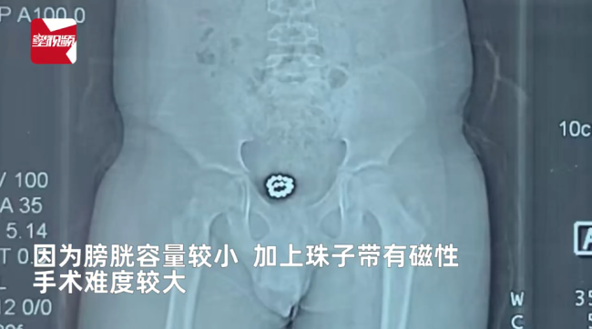 男孩膀胱塞入19粒磁珠1年后取出,都是好奇惹的祸,一直没说告知家长-第4张图片-9158手机教程网 男孩膀胱塞入19粒磁珠1年后取出,都是好奇惹的祸,一直没说告知家长-第4张图片-9158手机教程网