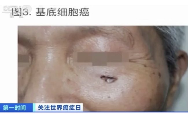 紧急提醒!这种癌症,发病率高!极易被忽视 一定要多注意及时发现治疗-第1张图片-9158手机教程网 紧急提醒!这种癌症,发病率高!极易被忽视 一定要多注意及时发现治疗-第1张图片-9158手机教程网