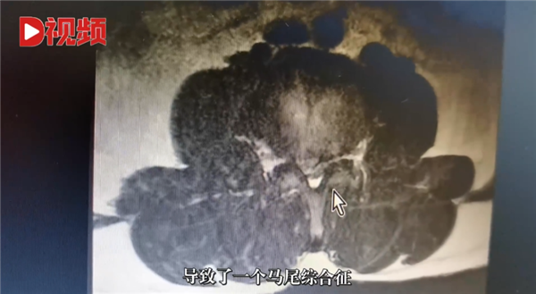 连续开车8小时!男子长期久坐后被诊断截瘫 医生提醒-第2张图片-9158手机教程网 连续开车8小时!男子长期久坐后被诊断截瘫 医生提醒-第2张图片-9158手机教程网