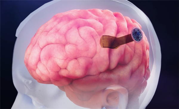 马斯克合伙人研制大脑“第七层” ：瘫痪病人可用意念操作电子设备-第1张图片-9158手机教程网